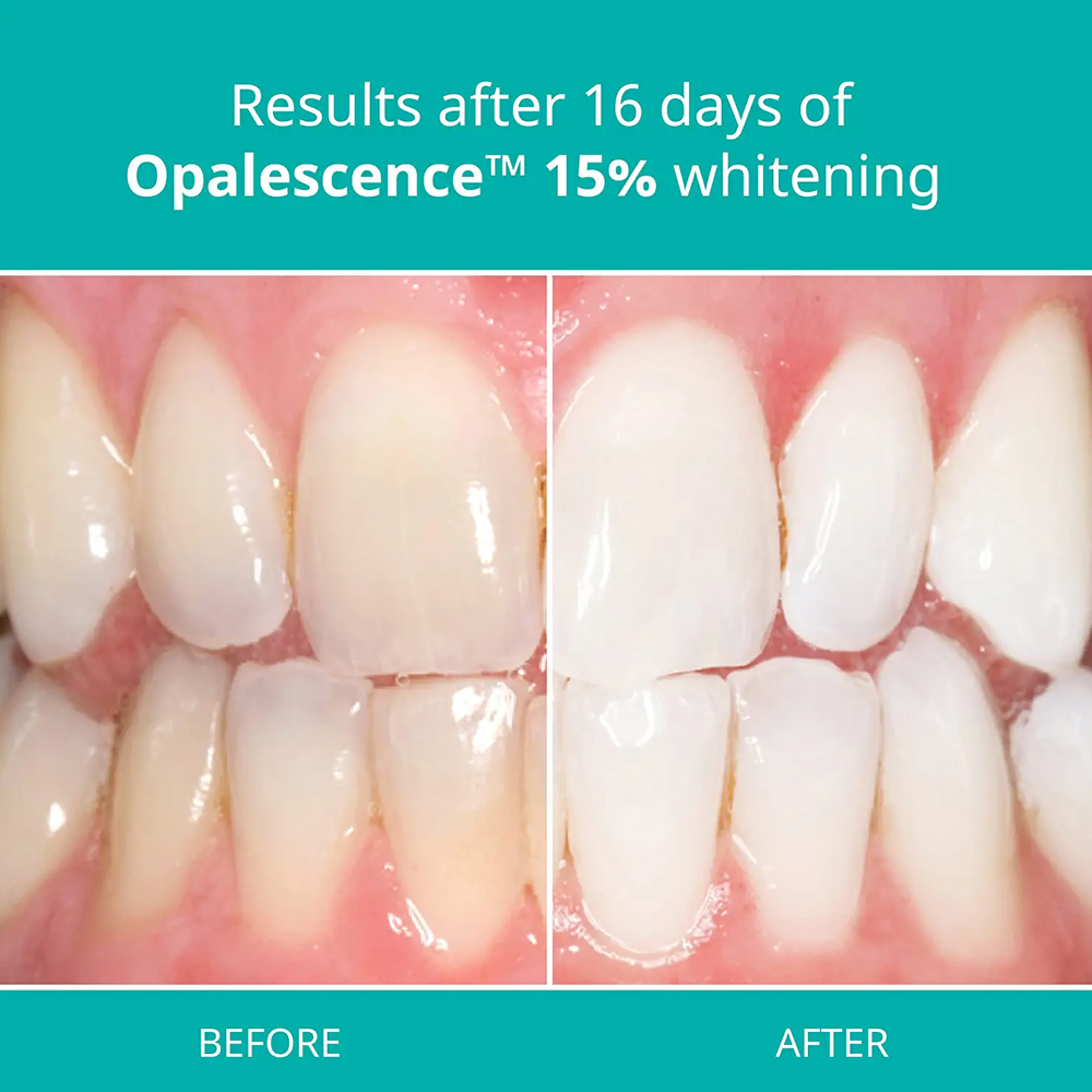 Opalescence Professional White - огляд і ціна Teeth Whitening Gel Syringes