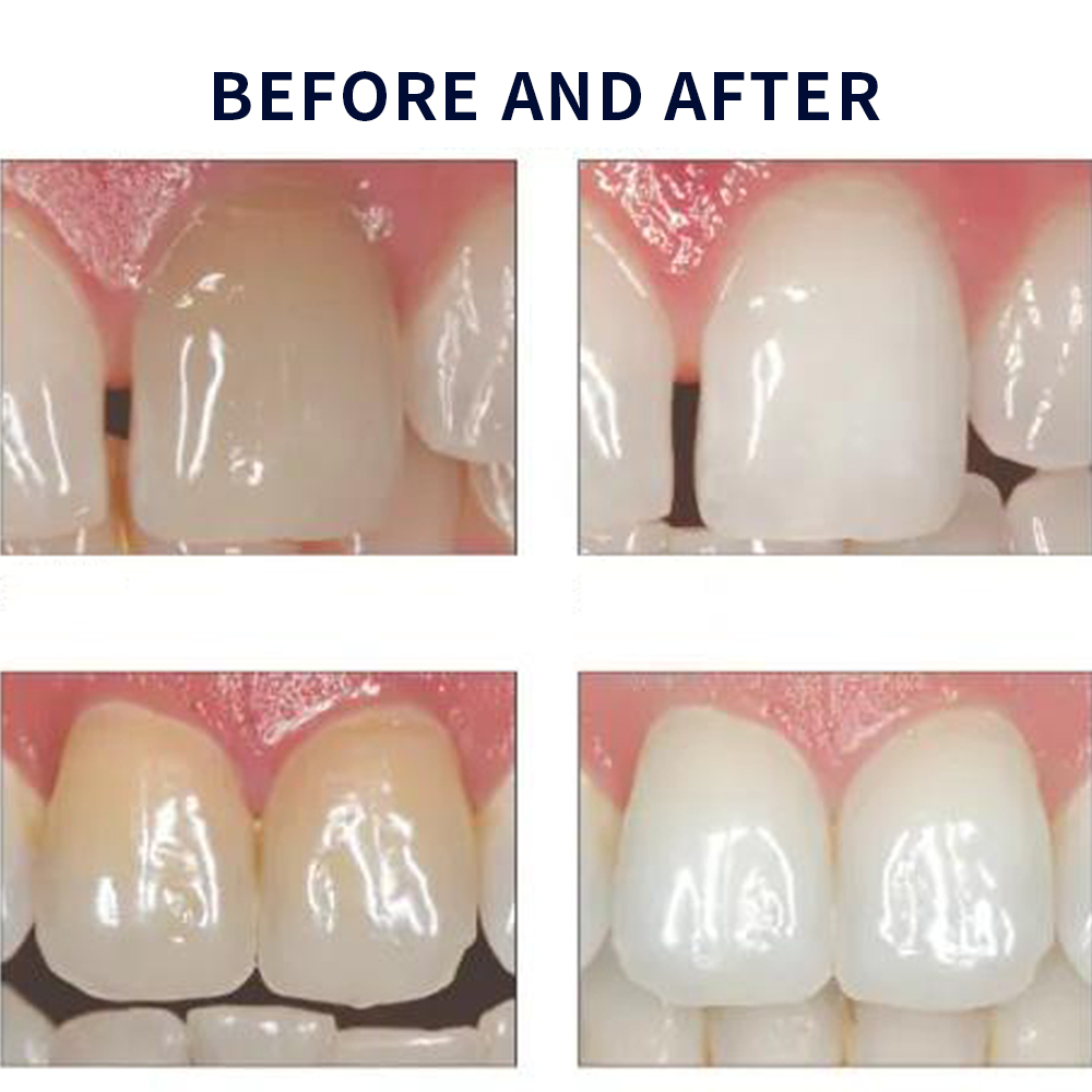 Opalescence Whitening 20% PF 2 - огляд і ціна Teeth Whitening With Hydrogen Peroxide
