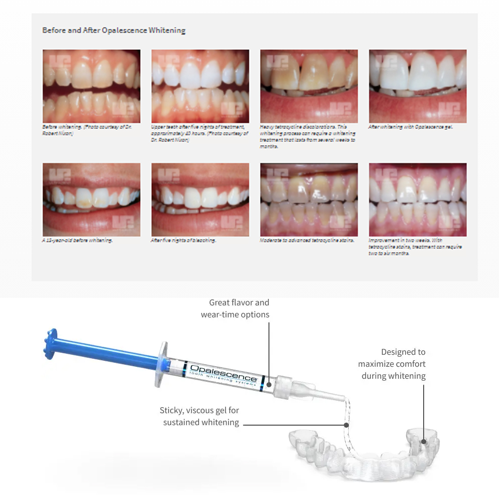 Opalescence Whitening 20% PF 2 - огляд і ціна Teeth Whitening With Hydrogen Peroxide
