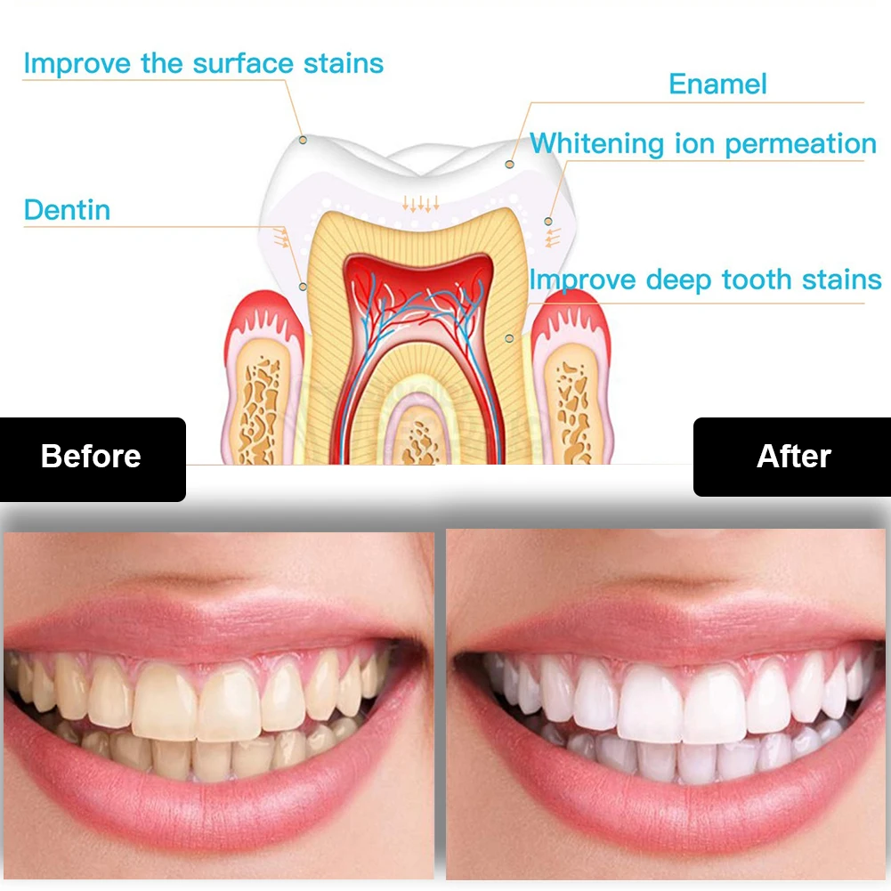 Dental Teeth Whitening Kit Min - огляд і ціна Teeth Whitening With Hydrogen Peroxide